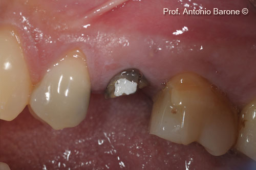 Fig.3 Clinical Buccal View of a fractured tooth ( #15)