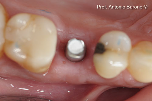Fig.20 Implant abutment.