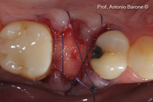 Fig.8 Clinical Occlusal View of a OsteoBiol® <i> Derma </i> matrix folded toward the palate and stabilized with resorbable cross-sutures