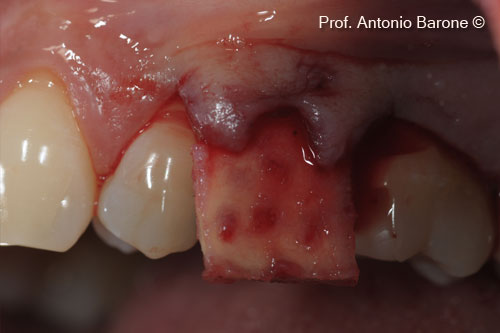 Fig.6 Clinical Buccal View of a OsteoBiol® <i> Derma </i> matrix inserted at the buccal side with an envelope flap