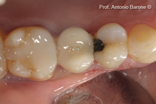 Fig.26 Clinical Occlusal view 5 years after implant placement