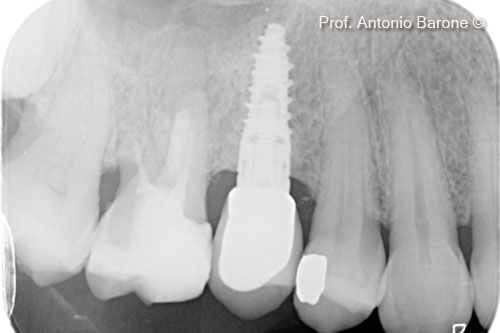 Fig.22 Periapical X-Ray 1 year after implant placement