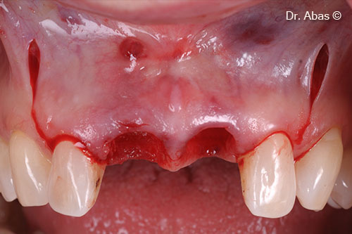 3. Incision design