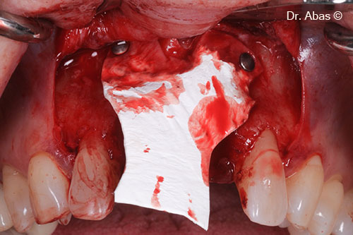 Extraction, guided bone regeneration...