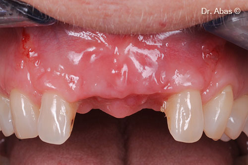 11. Soft tissue epithelialization 4 weeks post-op