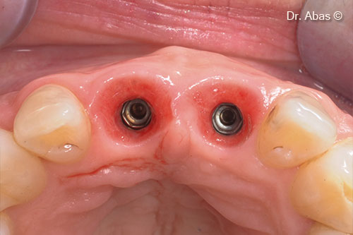 21. Cervical and emergence profile of the implants