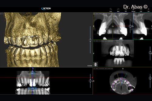 2. CBCT images of teeth 11 and 21
