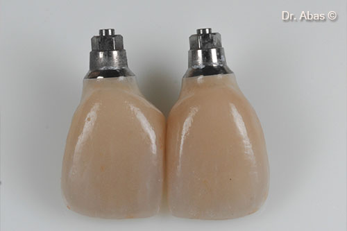 23. Baked porcelain on zirconia and titanium inserts
