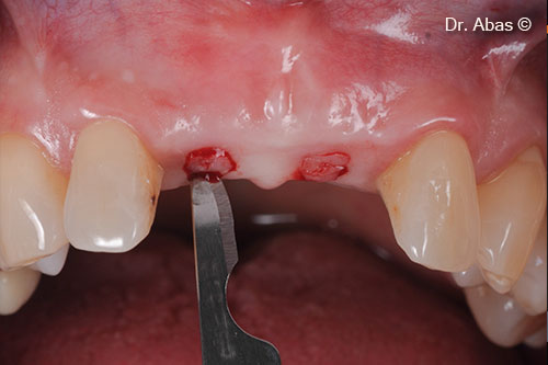 15. Circular incisions
