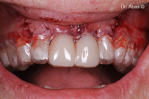 9. Essix retainer directly after surgery
