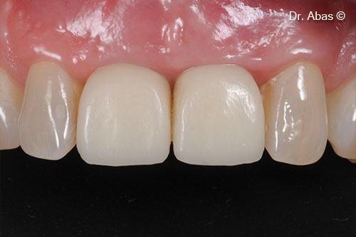 20. Maturation of soft tissues after 6 months