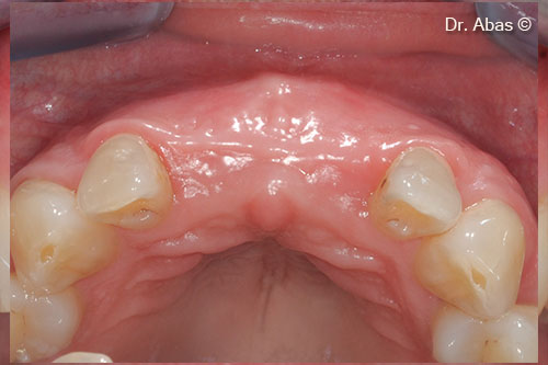 13. Sufficient width to implant flaplessly