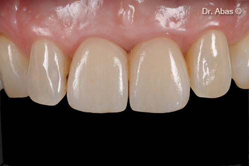 24. Final result front view
