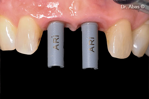 22. Two scan abutments in situ for digital impression