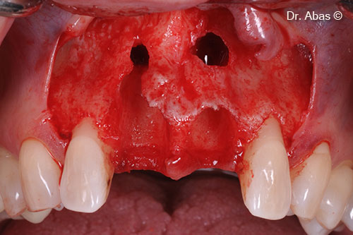 4. After retracting flap & curettage of inflammatory tissue