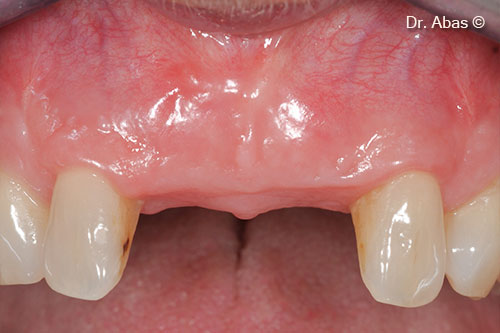 12. Healed jaw after 4 months