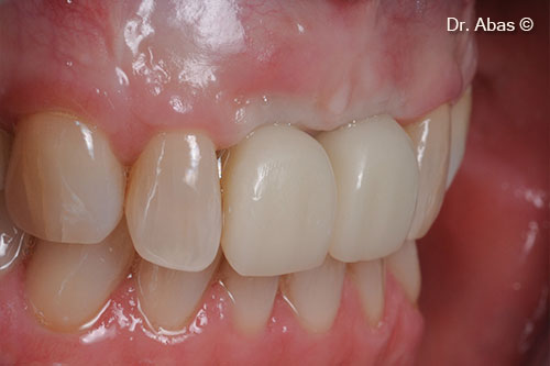 19. Temporary crowns immediately after implant placement