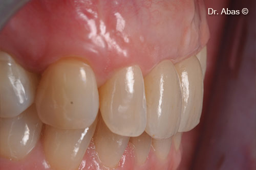 25. Sufficient thickness of tissues for a natural emergence profile