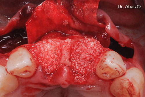 6. Alveoli reconstructed with sticky bone