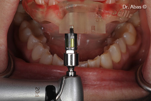17. Implant driver through guide
