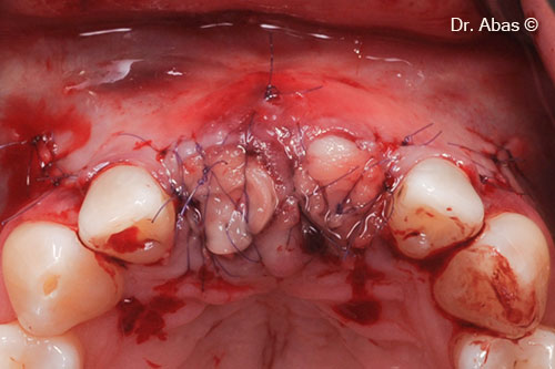 8. Wound primarily closed with PRF
