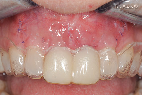 10. Two weeks postoperative
