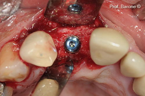 Implant inserted in the augmented ridge