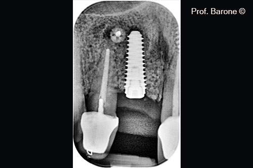 Periapical Radiograph 3 months after implant placement 