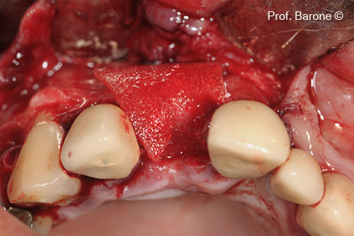 Treatment of an atrophic ridge