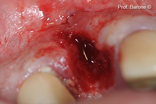 Tooth Extraction