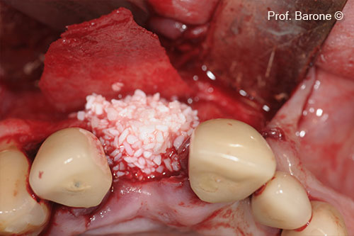 Bone Defect grafted with GTO