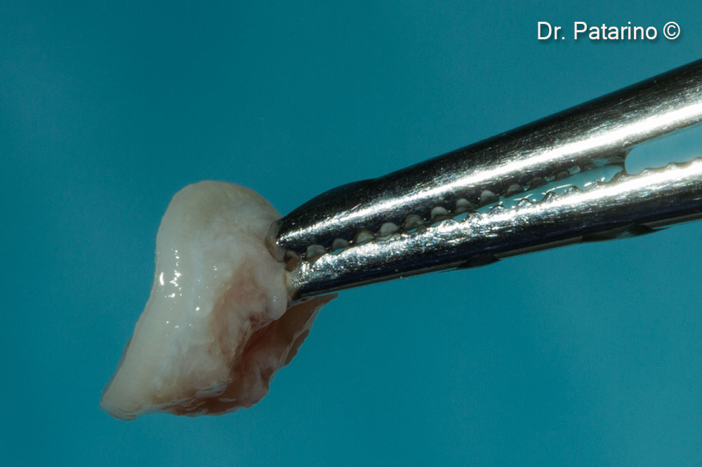 12. Connective Tissue Graft