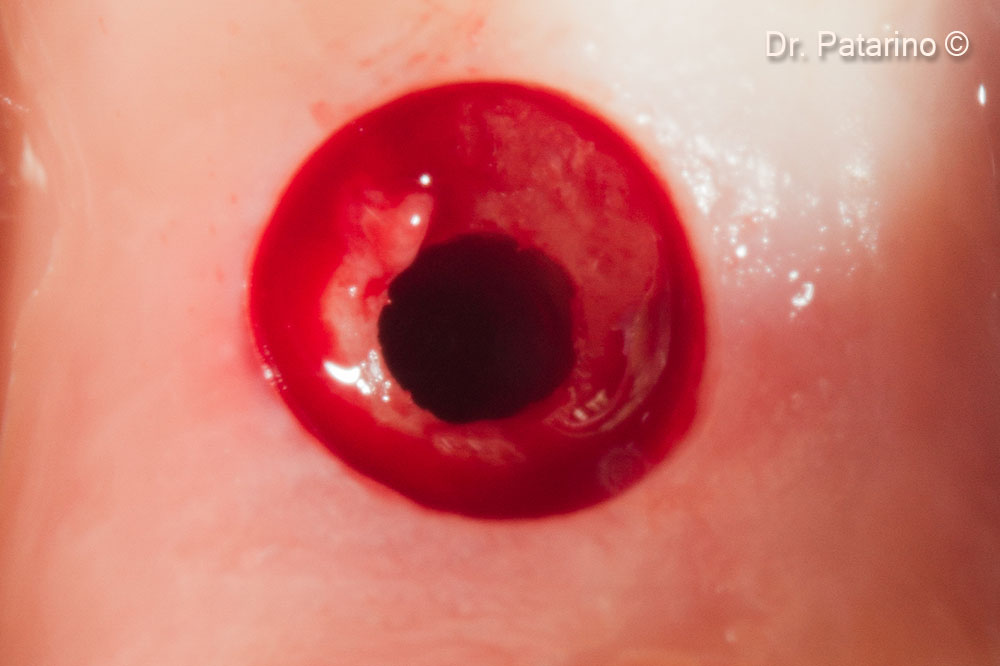 11. Connective Tissue Graft harvesting site