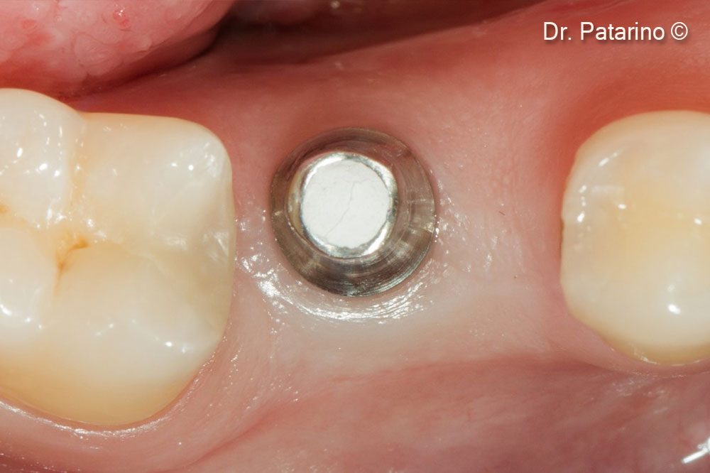 16. Clinical view 3 months after the insertion of the implant