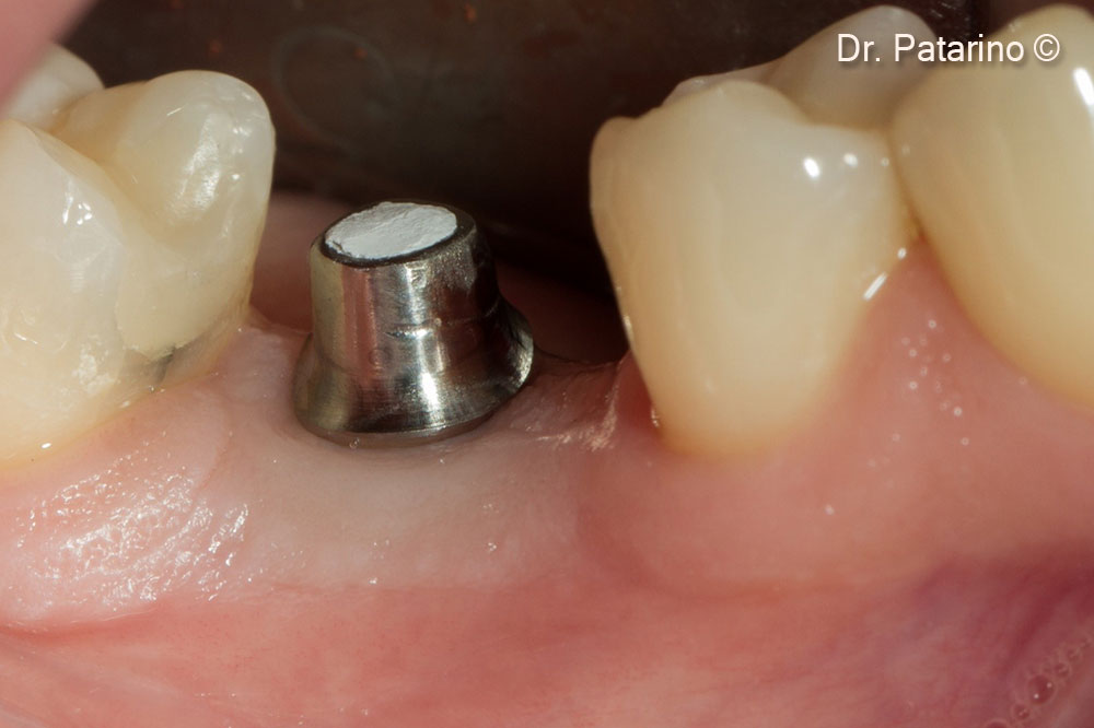 17. The mucogingival line is restored