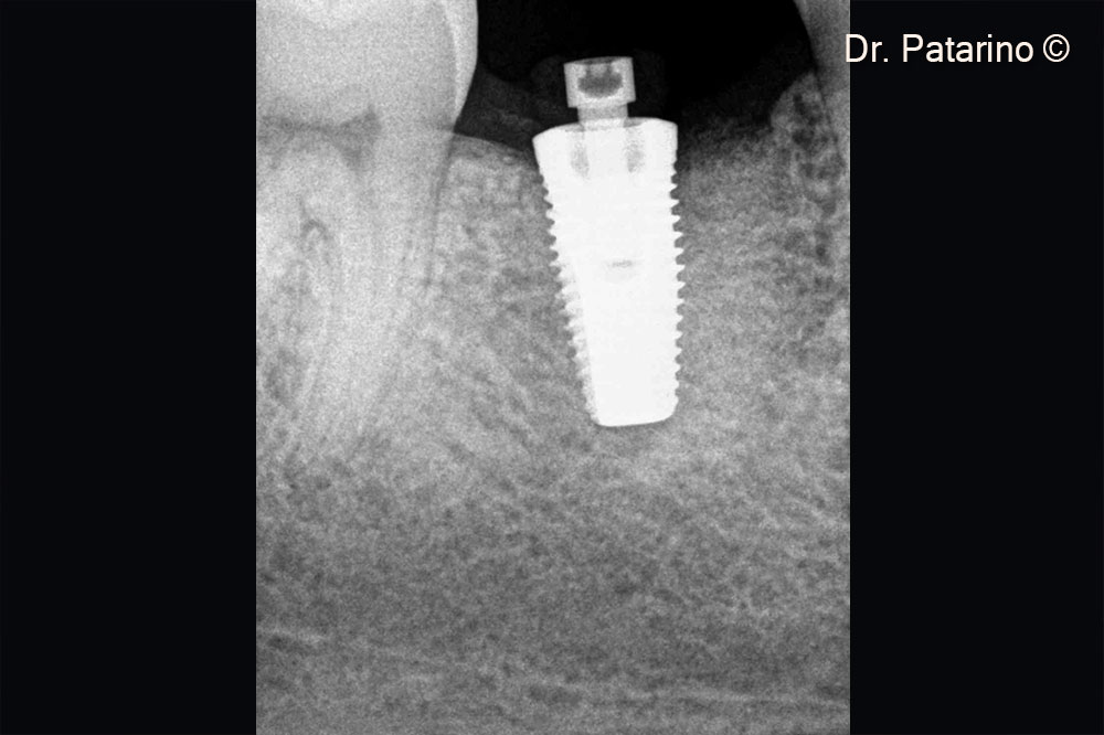 15. RX after implant placement