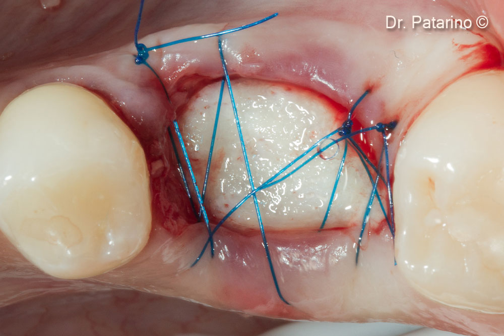 Volume preservation after tooth...