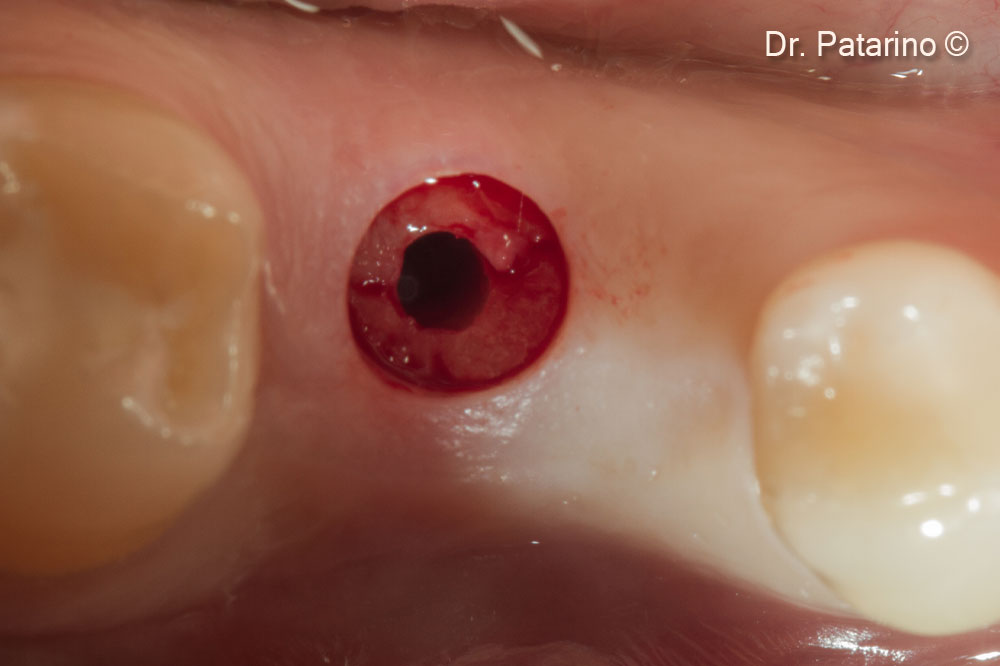 10. A 4.6 mm diameter implant is inserted with the flapless approach