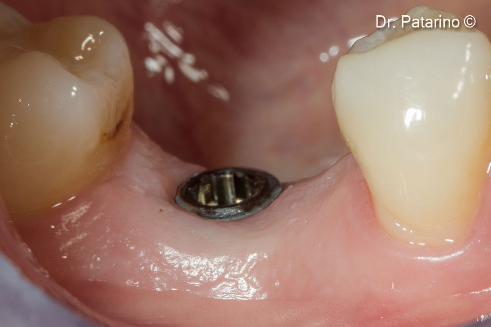 14. Implant placement - lateral view