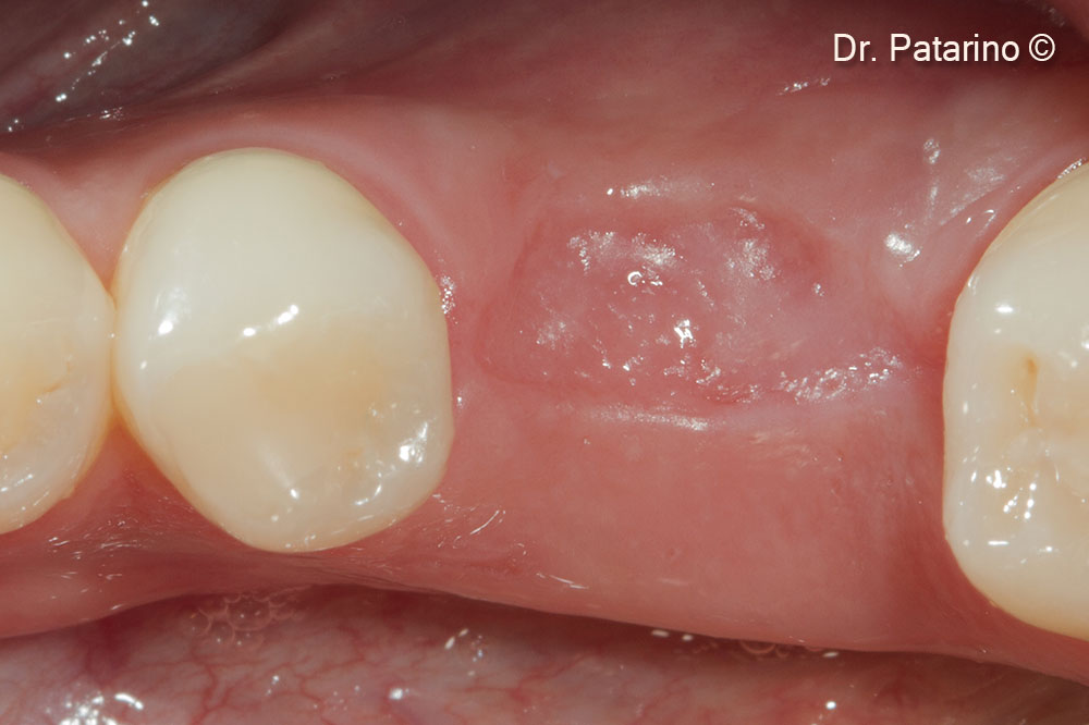 7. Soft tisses grew onto Derma