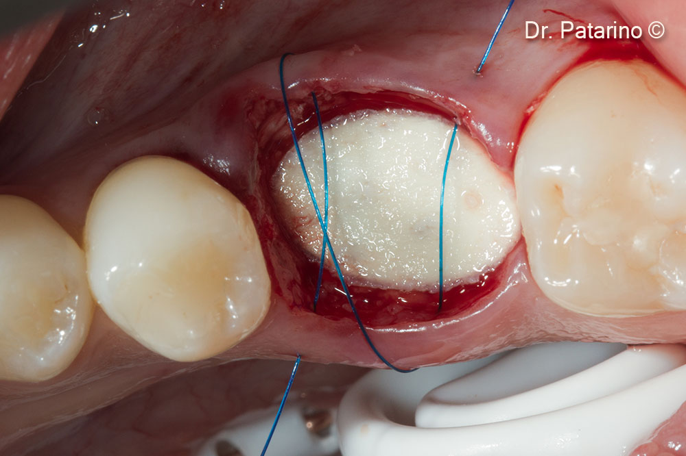 4. Derma is used to seal the socket