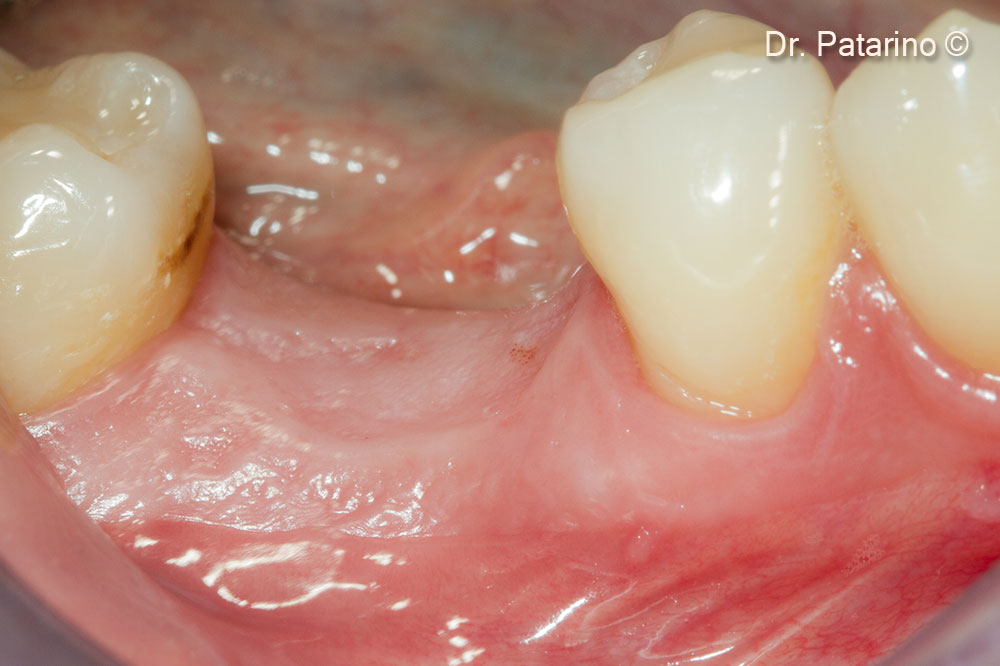 8 Clinical view after 6 months