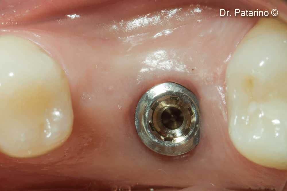 13. Implant placement - occlusal view