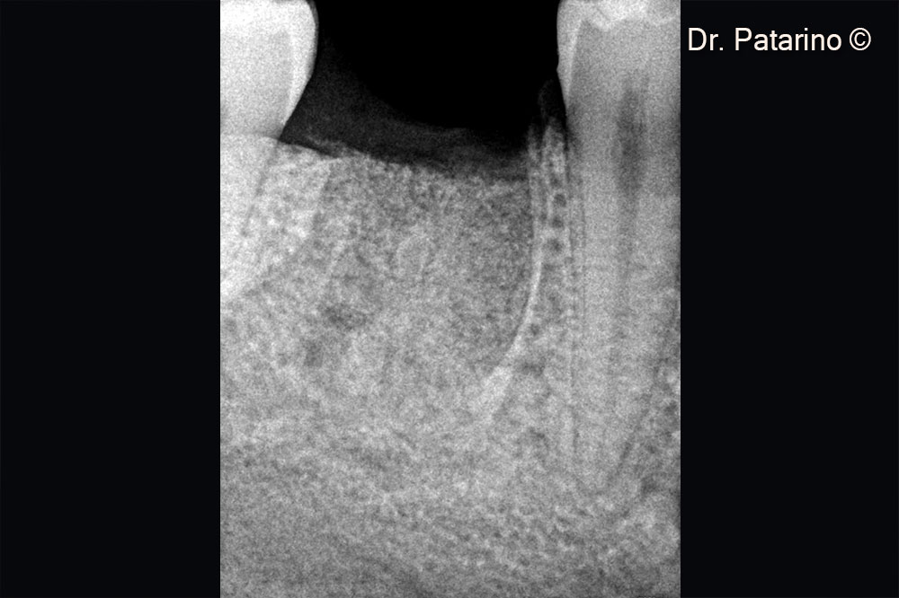 6. Post-op RX