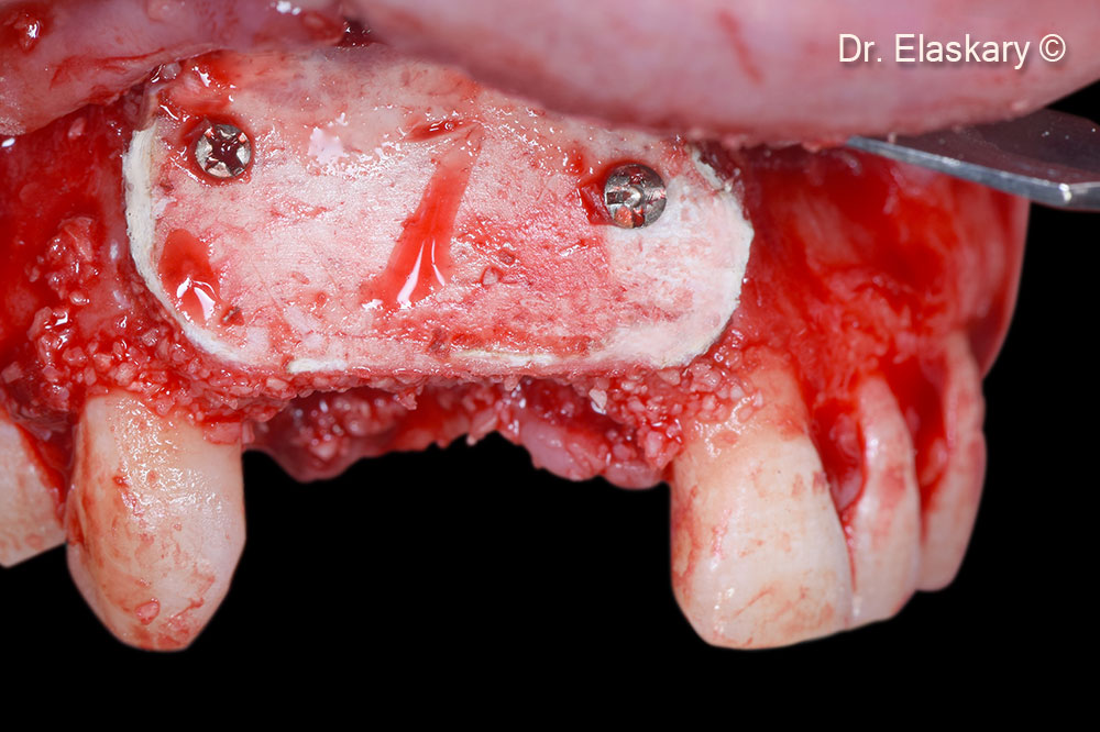 8.  Soft Cortical Lamina is stabilized from the palatal to the labial side to protect the bone graft occlusally