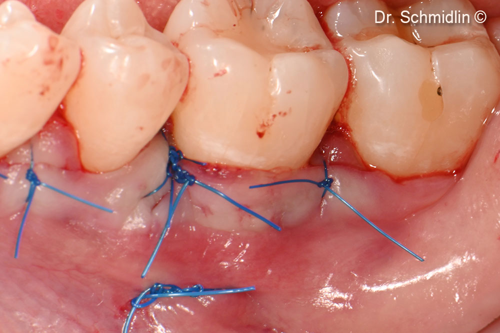 Site after final suturing