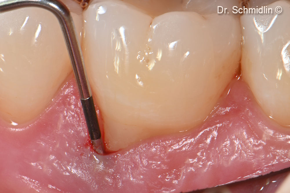 Periodontal probing of the affected site 