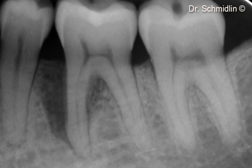 Preoperative Xray