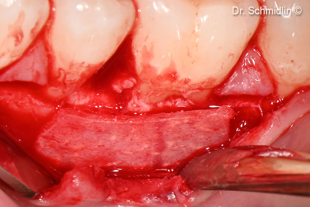 Treatment of a periodontal defect