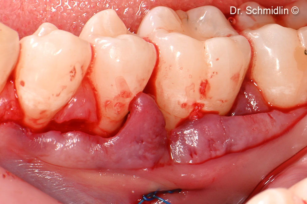 Tension free mobilzation of the flap